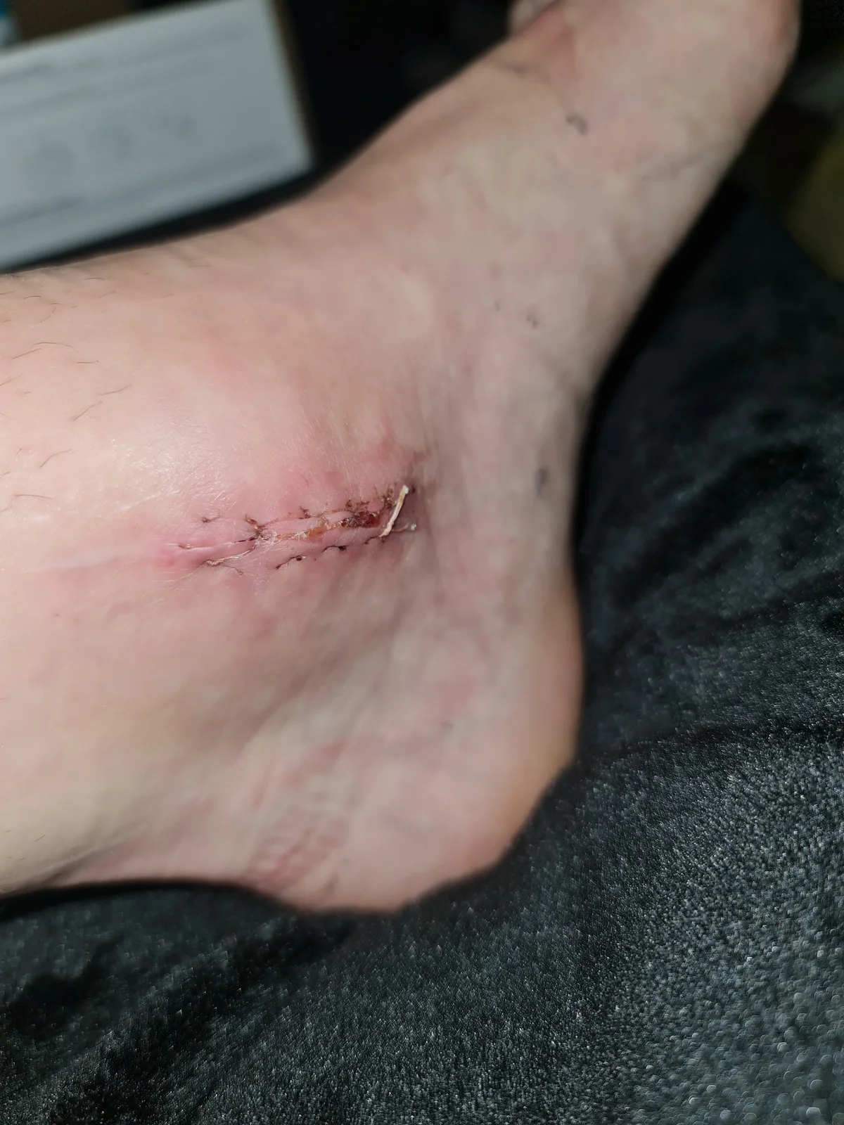 État de la cheville après une fracture survenue en compétition — photo 6