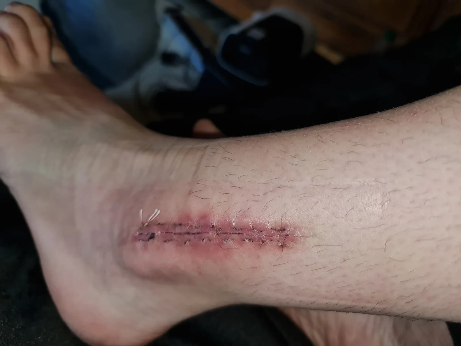 État de la cheville après une fracture survenue en compétition — photo 8